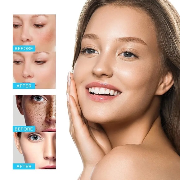 Whitening Freckle Cream Remove Melasma Cream Remove Dark Spots Melanin Brighten - Picture 4 of 4
